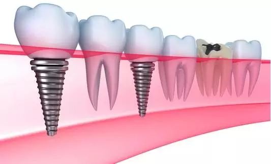 牙齿缺失后该怎么办