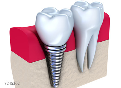 种植牙寿命