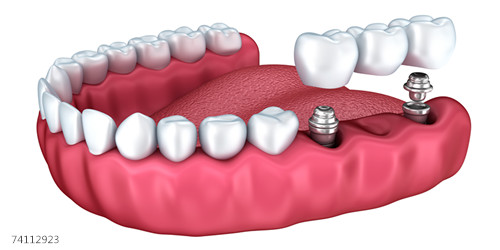 种植牙的知识大全